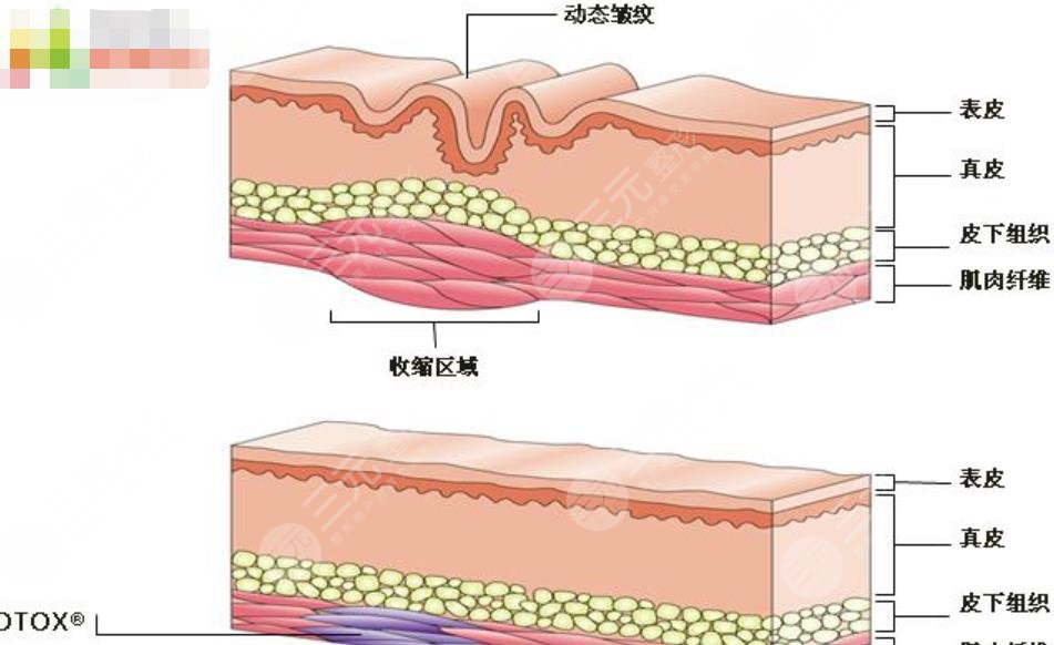 玻尿酸除皱可以维持多长时间?3大原因影响了维持时间,是哪三点呢?