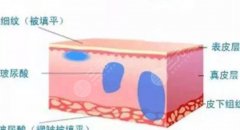 玻尿酸除皱有果吗？玻尿酸除皱果维持时间及术后保养注意事项