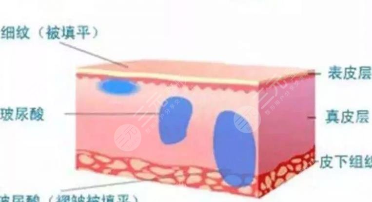 玻尿酸除皱有果吗?玻尿酸除皱果维持时间及术后保养注意事项