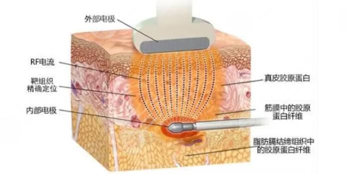 3d射频紧肤去皱项目表202