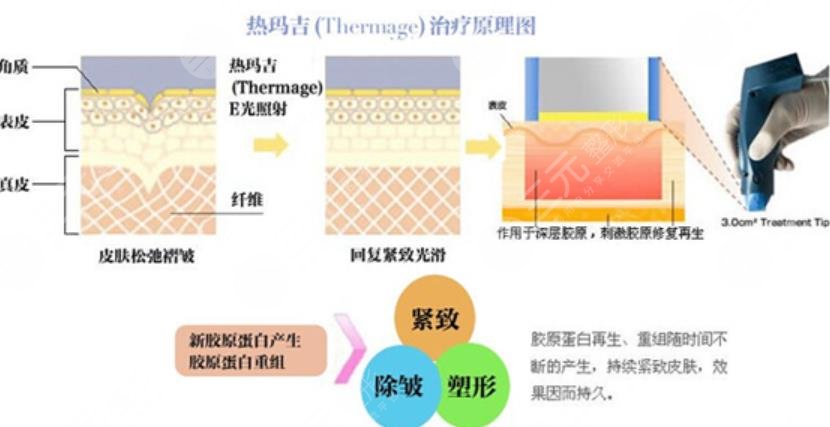 热玛吉手术