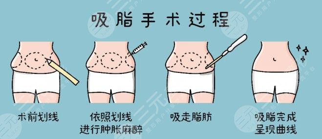 5g天使光雕吸脂