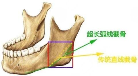 下颌角整形
