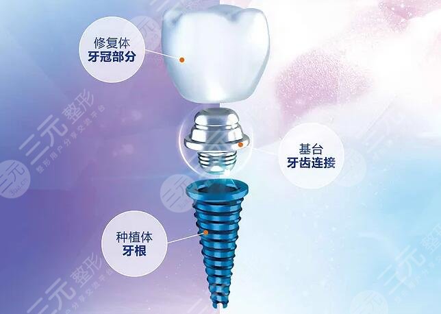 种植牙技术有什么特点呢