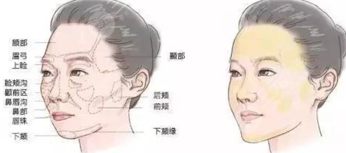 脂肪填充除皱能维持多久