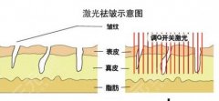 激光除皱原理是什么，多少钱？想要get理想果，注意事项不能忘！