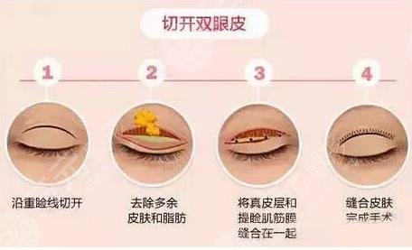 修复双眼皮的十大专家