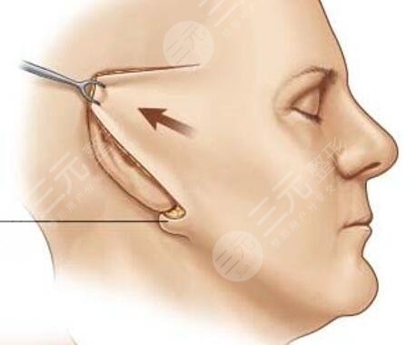 什么年纪做拉皮手术比较好