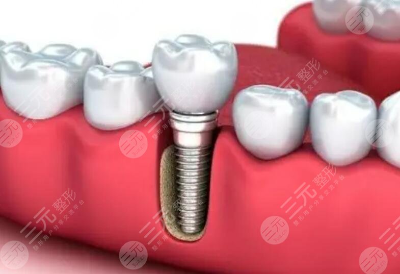 种植牙技术过程复杂吗