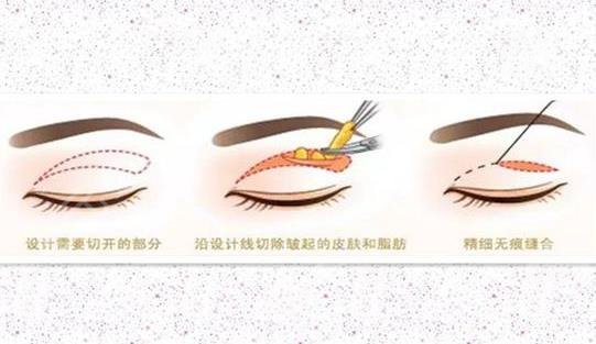杭州有名的双眼皮整形医生