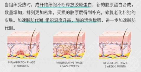 热玛吉和7d聚拉提的区别同在哪里?