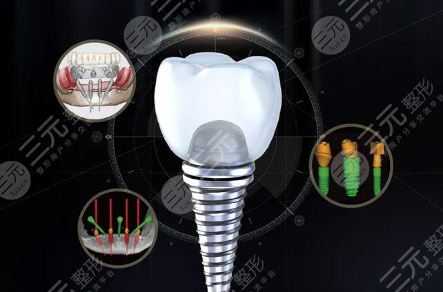 种植牙有什么特点