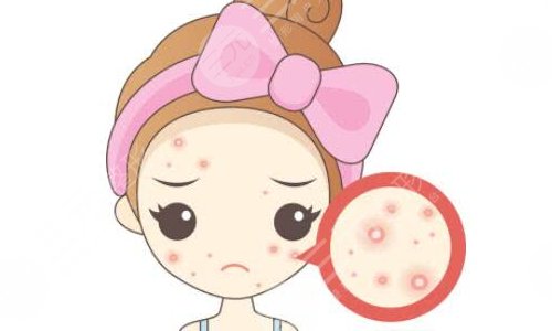 去痘坑有的方法|激光去痘坑到底有没有果?术后护理盘点~ 去痘坑有的方法|激光去痘坑到底有没有果?术后护理盘点~