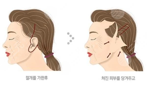 水波拉皮是怎么做的