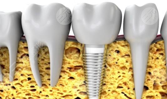 种植牙