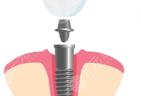 种植牙