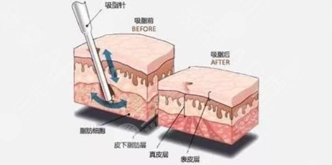 5G天使光雕吸脂