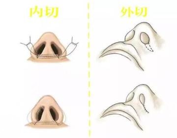 鼻翼缩小