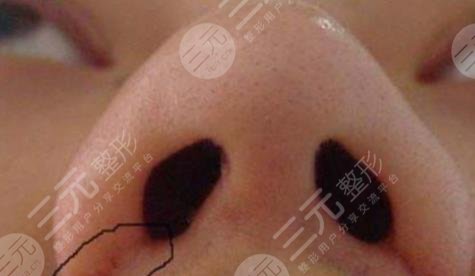 鼻翼缩小