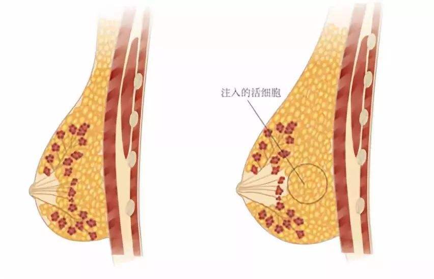脂肪胸是什么,填充能管多久?科普攻略带你了解美波如何“炼成”! 脂肪胸是什么,填充能管多久?科普攻略带你了解美波如何“炼成”!