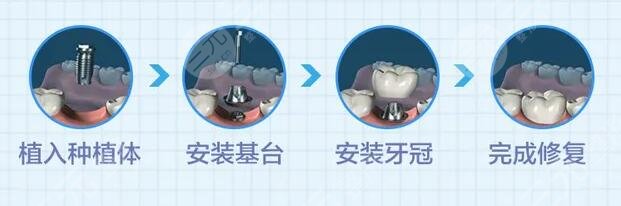 种植牙一般要多长时间