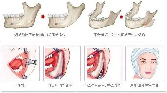 颌角整形手术术后会留下疤痕问题吗