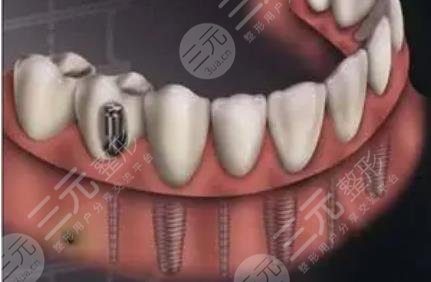 种植牙