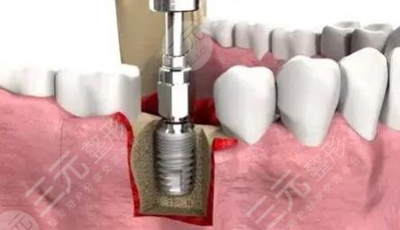 种植牙