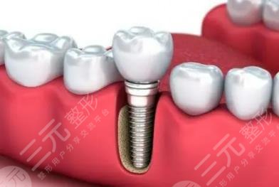 种植牙