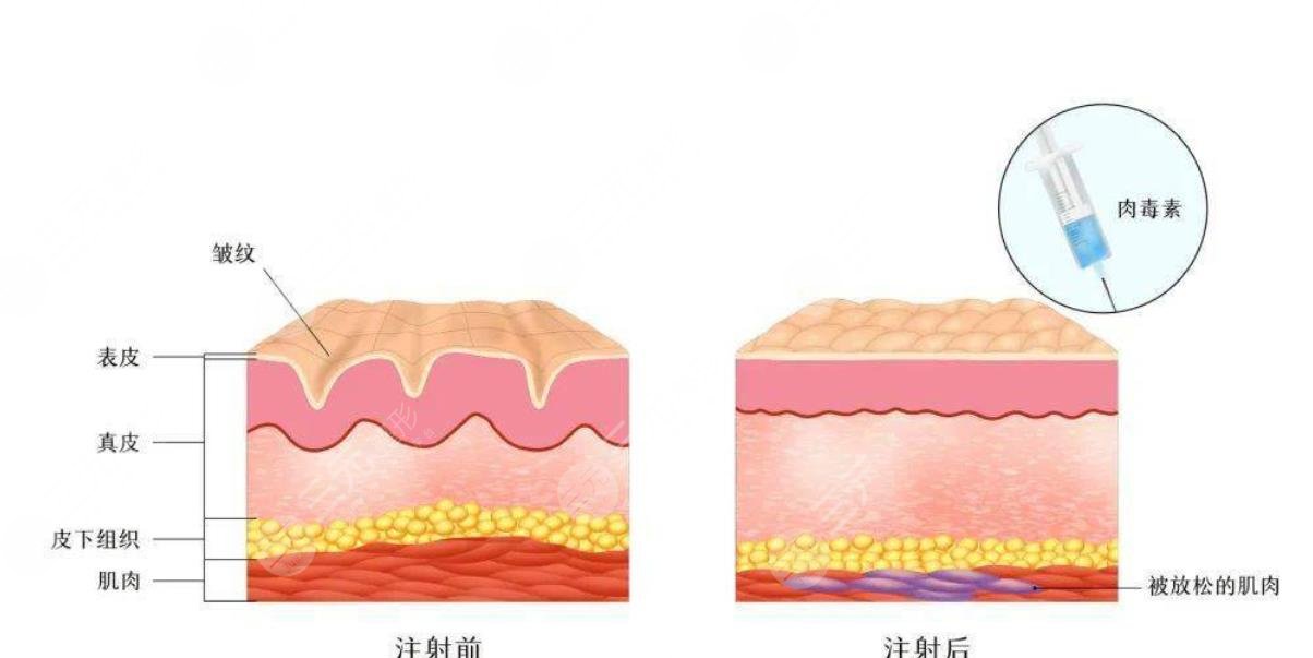 B****除皱能维持多久