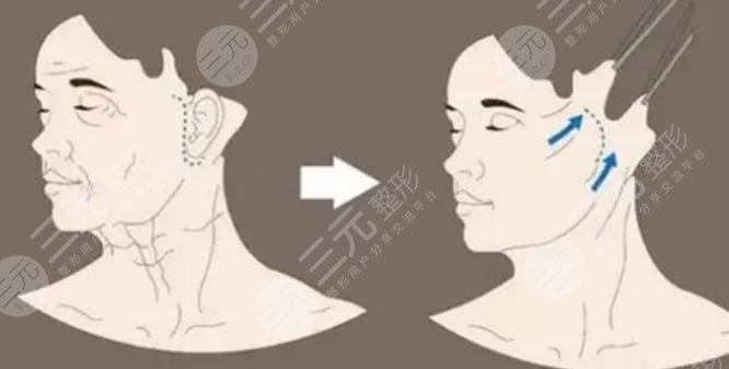 出现瘢痕