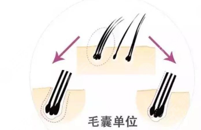 体毛种植