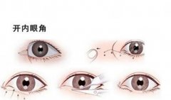 开眼角和不开的区别图对比来袭，哪个好看你来品！科普手术知识！