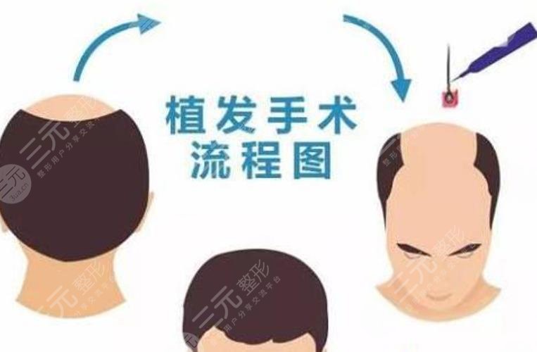 植发
