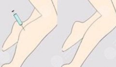 注射瘦腿的副作用科普！医美别光看果，注意事项不能忘！