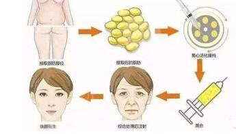 如何维持脂肪填充除皱果