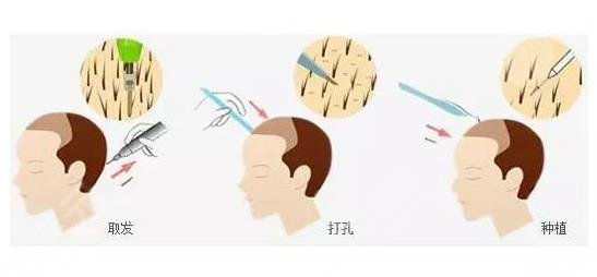 上海八五医院植发科头顶加密种植项目科普