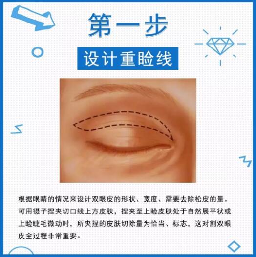 切双眼皮全过程图文科普来咯！6步造就电力媚眼，你细品！