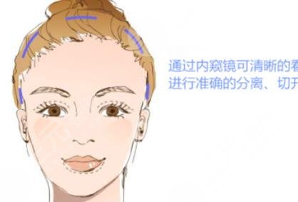 小拉皮手术