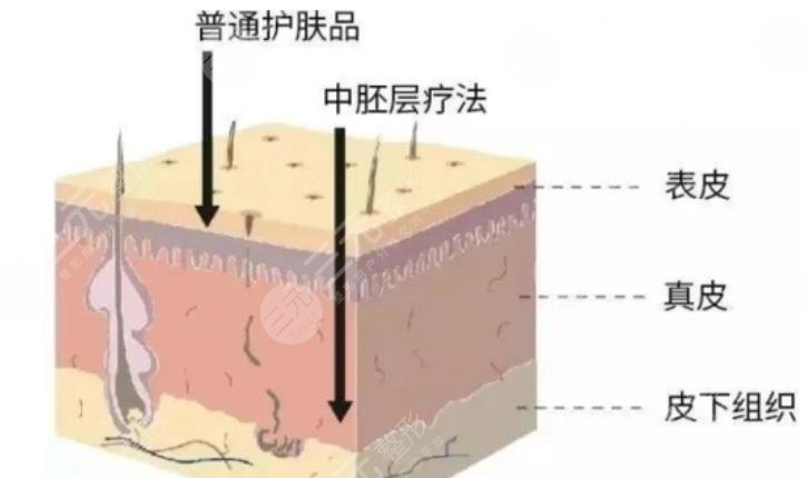 中胚层抗衰价格是多少?果怎么样?附原理介绍! 中胚层抗衰价格是多少?果怎么样?附原理介绍!
