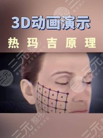 热玛吉