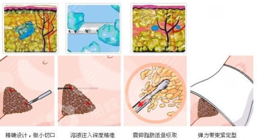 抽脂手术动图演示手术原理！成好吗？价格+选择攻略，助力好身材！