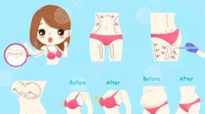 吸脂丰胸