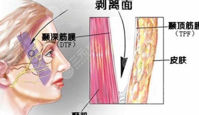 拉皮手术