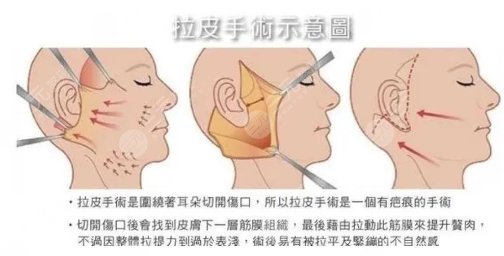 小拉皮手术