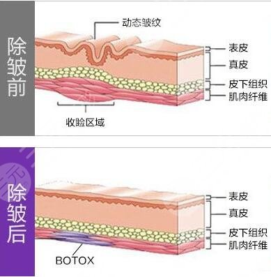 B****除皱后都有什么注意事项