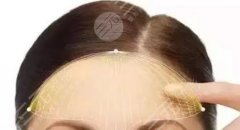 填充额头多少钱？玻尿酸or自体脂肪？一文详解丰额头的秘籍，马住！