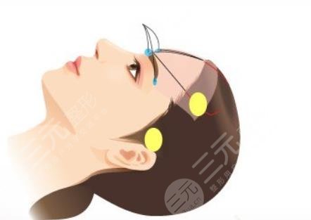 小拉皮手术