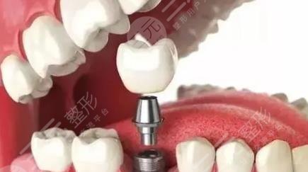 牙齿种植
