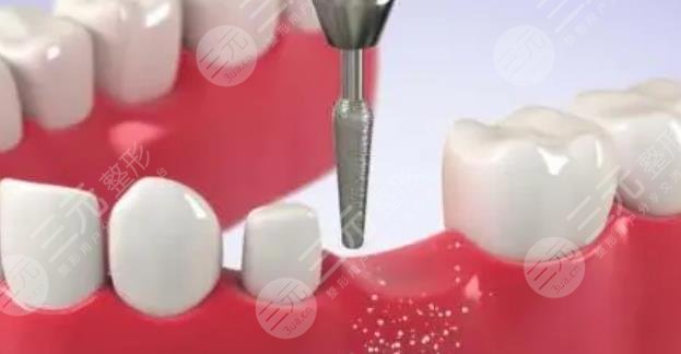 牙齿种植